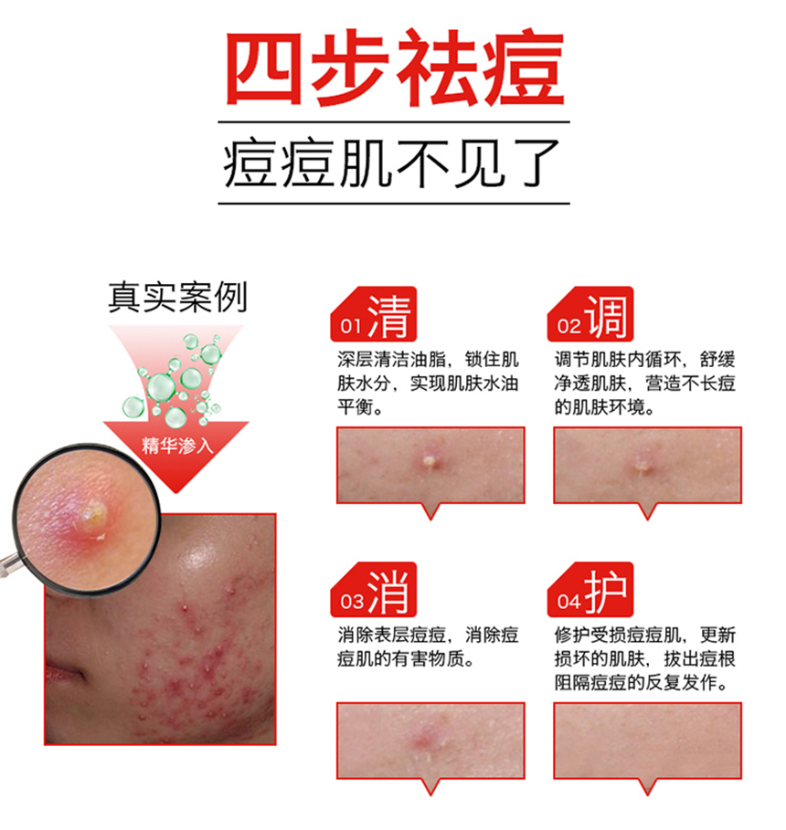 痘儿修护精华（女士）860详情图_06.jpg